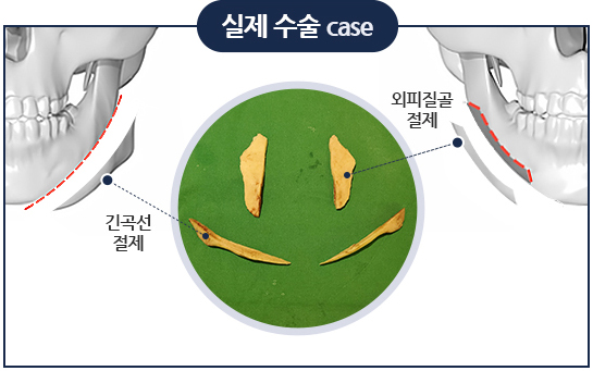 사각턱, 사각턱 수술, 긴곡선 절제술, 돌려깎기 - 지앤지병원 이비인후과